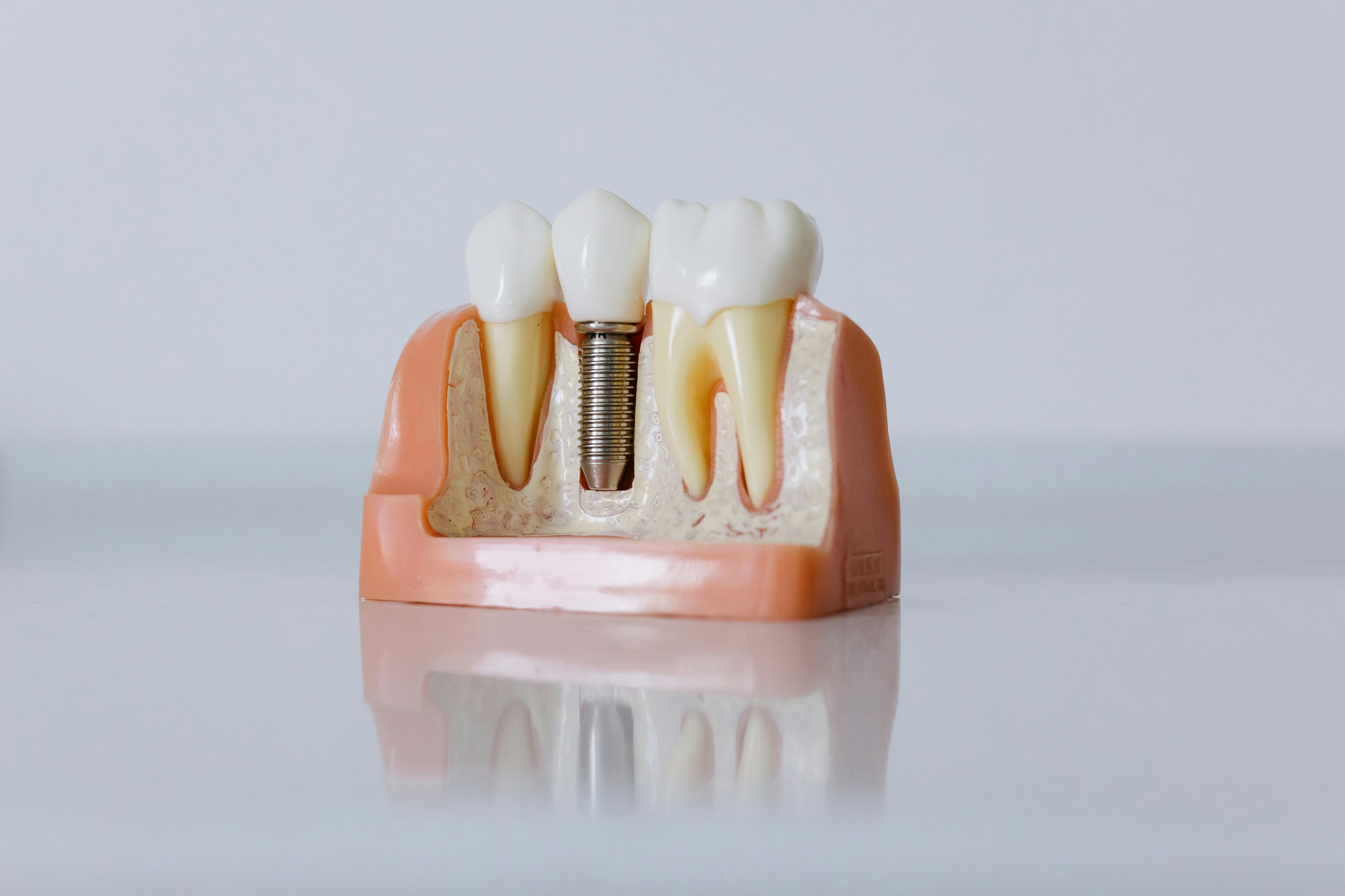 Implant therapy is a modern and reliable way to restore missing ...