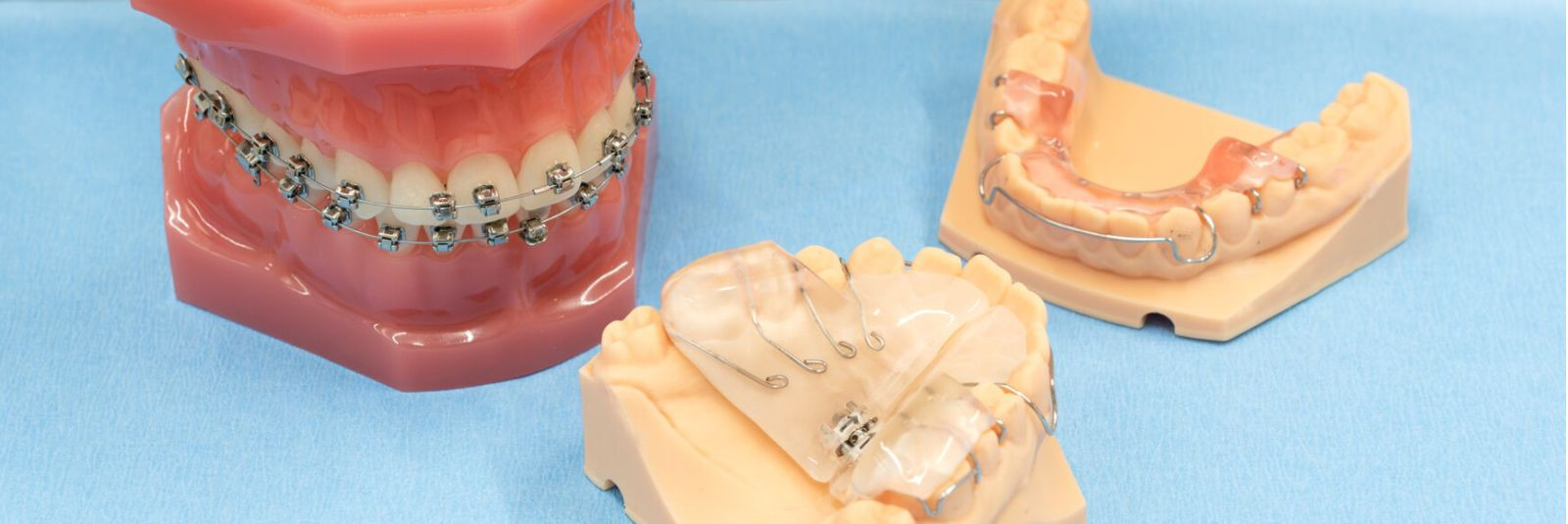 Kaped ja breketid on hindamatud abivahendid hammaste reastamiseks ning valehambumuse korrigeerimiseks. Ent nende pikaajaline kasutamine nõuab hoolikat kodust ho