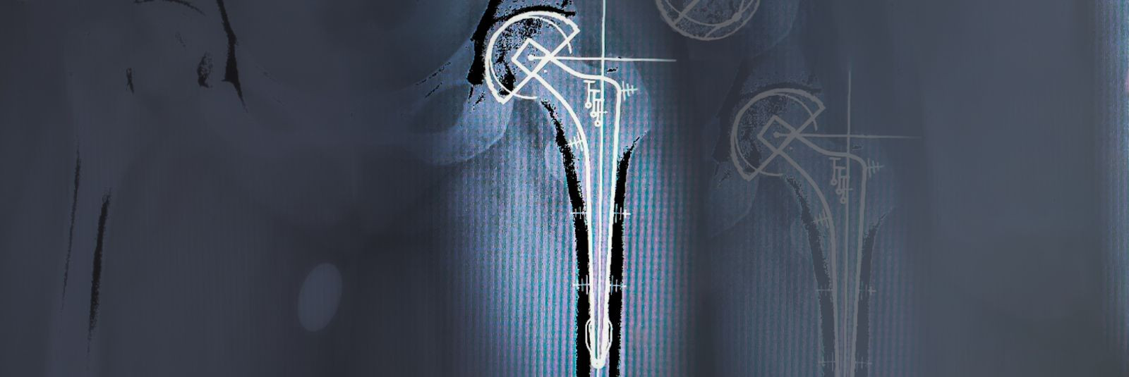 Liigese kulumine ehk artroos on haigus, mis võib põhjustada ...