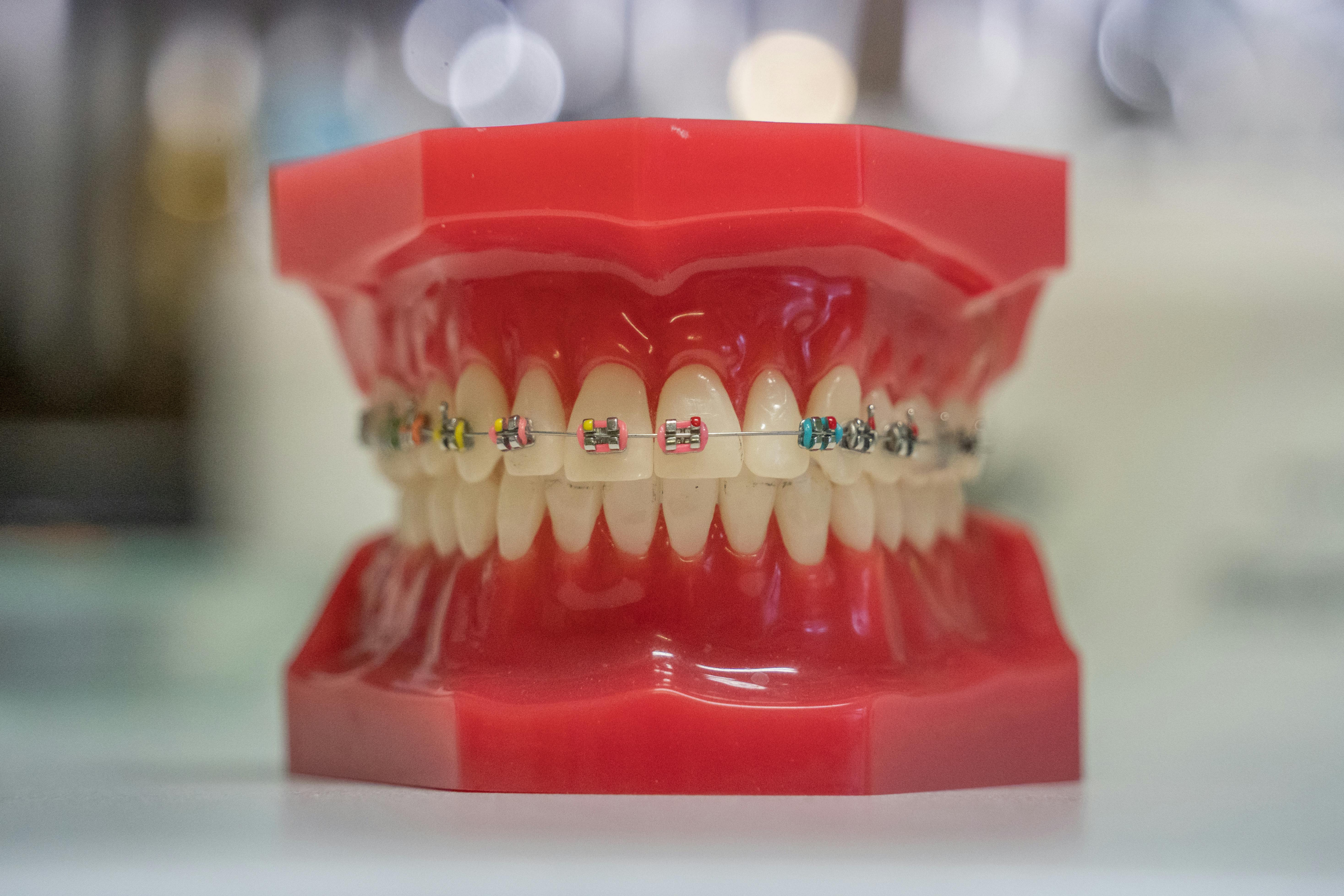 The treatment of the teeth helps to improve the position of the teeth, the consistency of the jaws and the whole function of the oral cavity. If the teeth do no